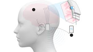 “نيورالينك” المملوكة لماسك: زرع شرائح الدماغ لدى 12 شخصا