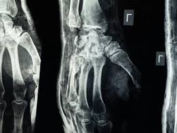 “غراء عظمي”.. ابتكار صيني لعلاج الكسور في 3 دقائق