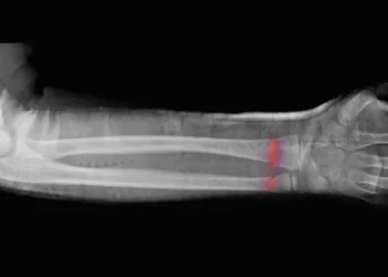 إنكلترا تختبر الذكاء الاصطناعي لتشخيص الكسور بدقة