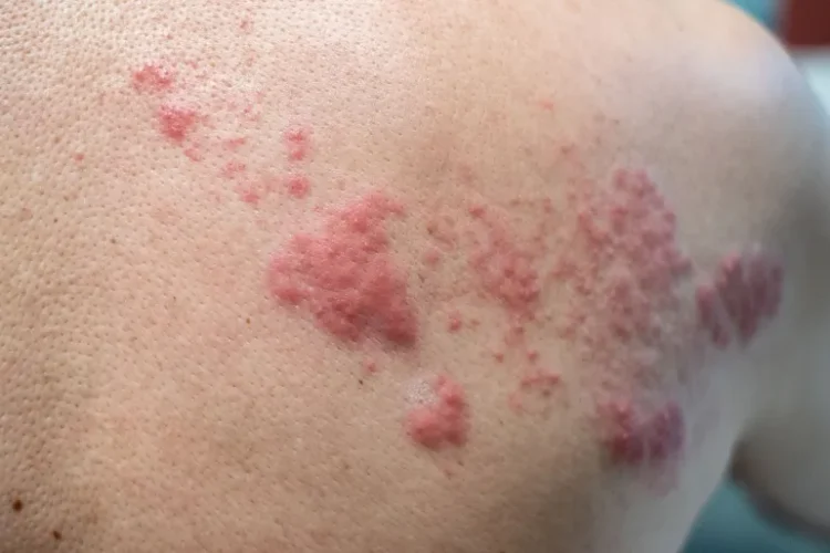 الطفح الجلدي من أبرز أعراض الهربس النطاقي حيث تتشكل بثور مملوءة بالسوائل وتتخذ شكل الحزام (شترستوك)