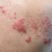 ماذا تعرف عن الهربس النطاقي؟
