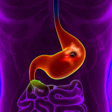 ما متلازمة “مالوري-وايس”؟